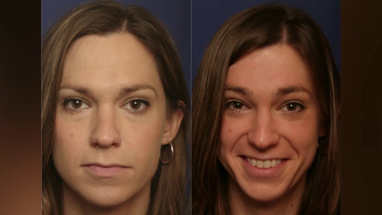 The People Who Have Undergone Facial Feminization | TransSingle