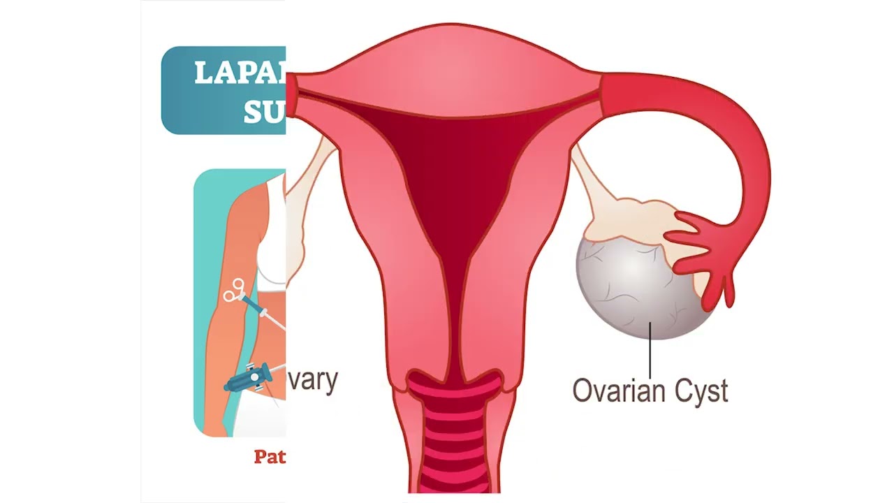 How Doctors Diagnose Endometriosis | Key Tests Explained | Dr Satabdi Dey
