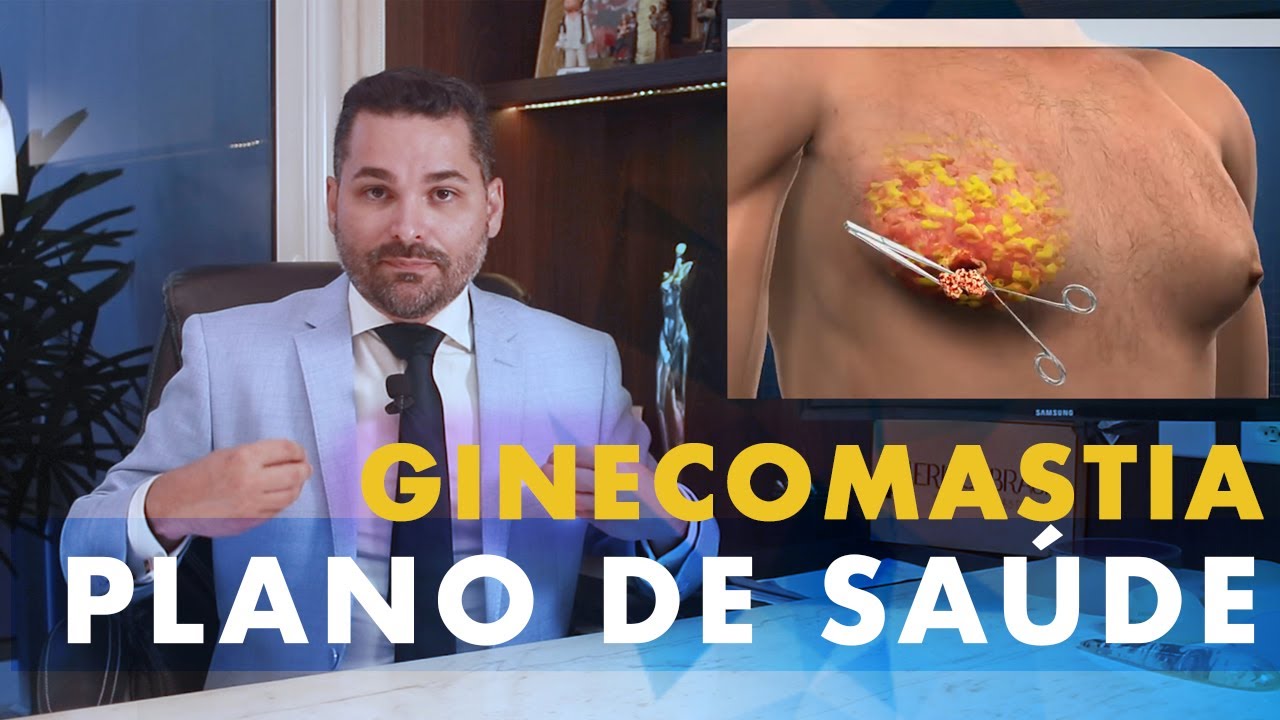 GINECOMASTIA Plano de saúde cobre? Posso fazer a cirurgia de ginecomastia pelo plano?