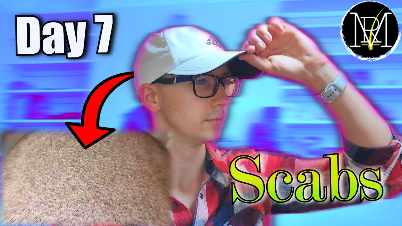 Day 7 after FUE/DHI Hair Transplant. Scab Removal | Wearing a Hat