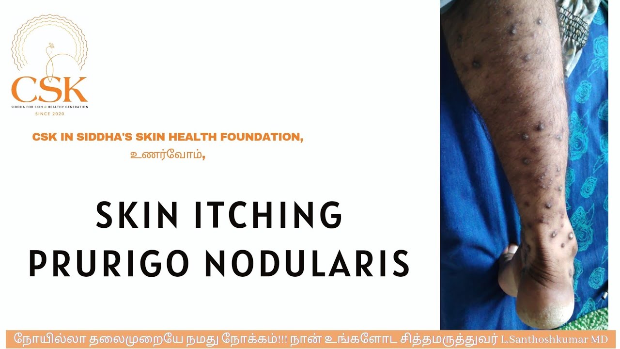 CSK IN உணர்வோம் PRURIGO NODULARIS SKIN ITCHING TAMIL symptoms,causes, natural treatment,diagnosis,DD