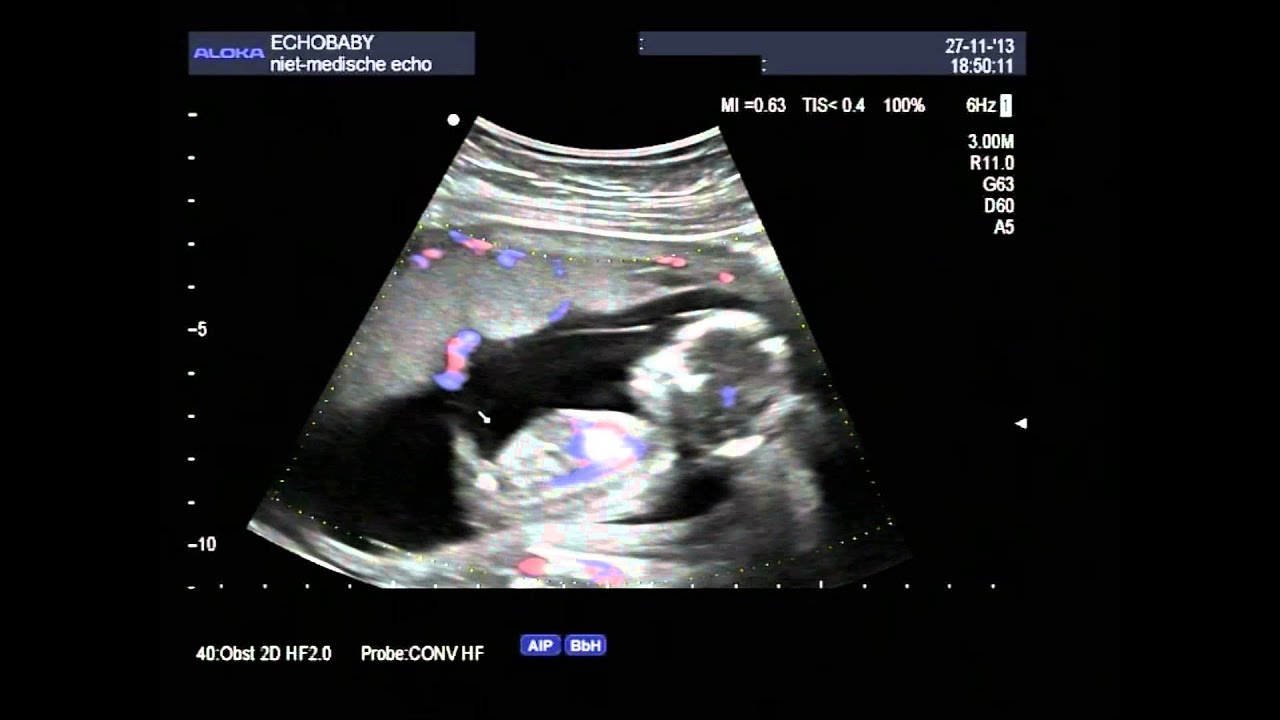 2D echo meisje 14 weken zwanger met ingesproken uitleg, kindje ademt en drinkt