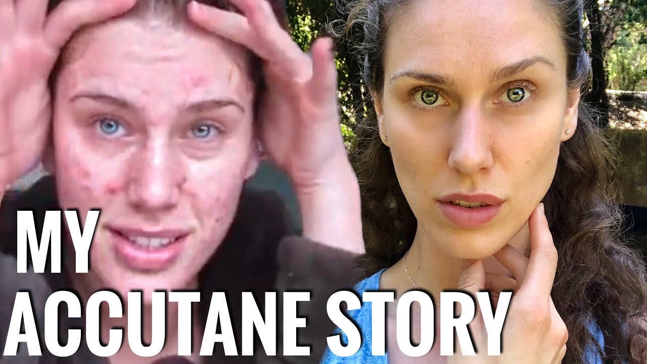 My Accutane Story (My Acne Meds + Why I Never Took Isotretinoin/Accutane )