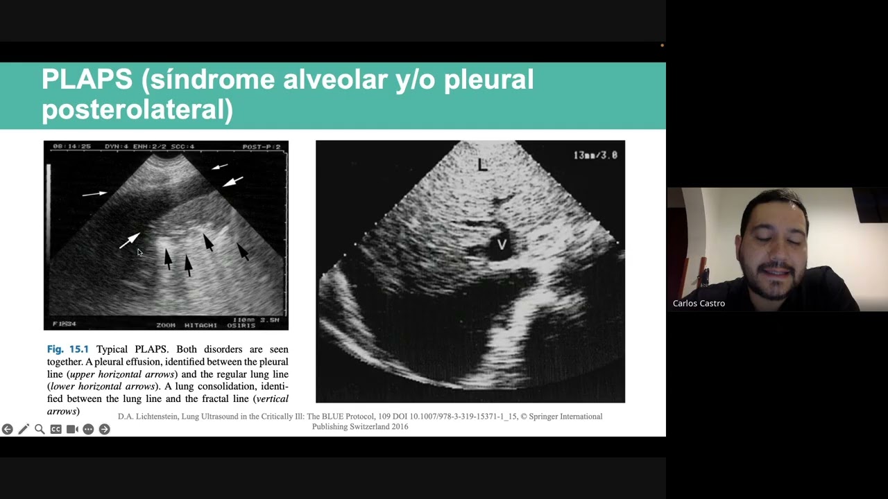 Valoración de derrame pleural por ultrasonido, escenarios POCUS