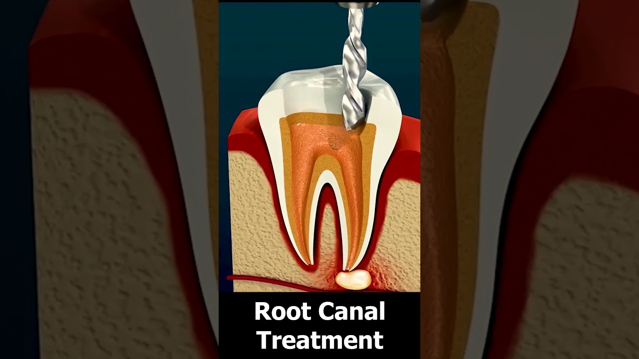 Root Canal Treatment & Tooth Abscess #rootcanal #medicalasmr #medicalart