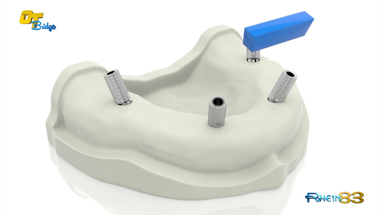 OT BRIDGE TECHNIQUE: FIXED PROSTHESIS RESTORATIONS