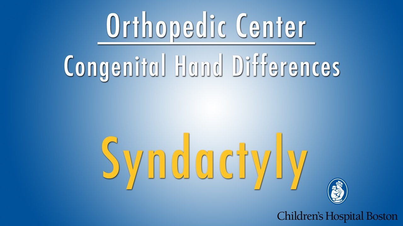 syndactyly - congenital hand differences - Boston Children's Hospital