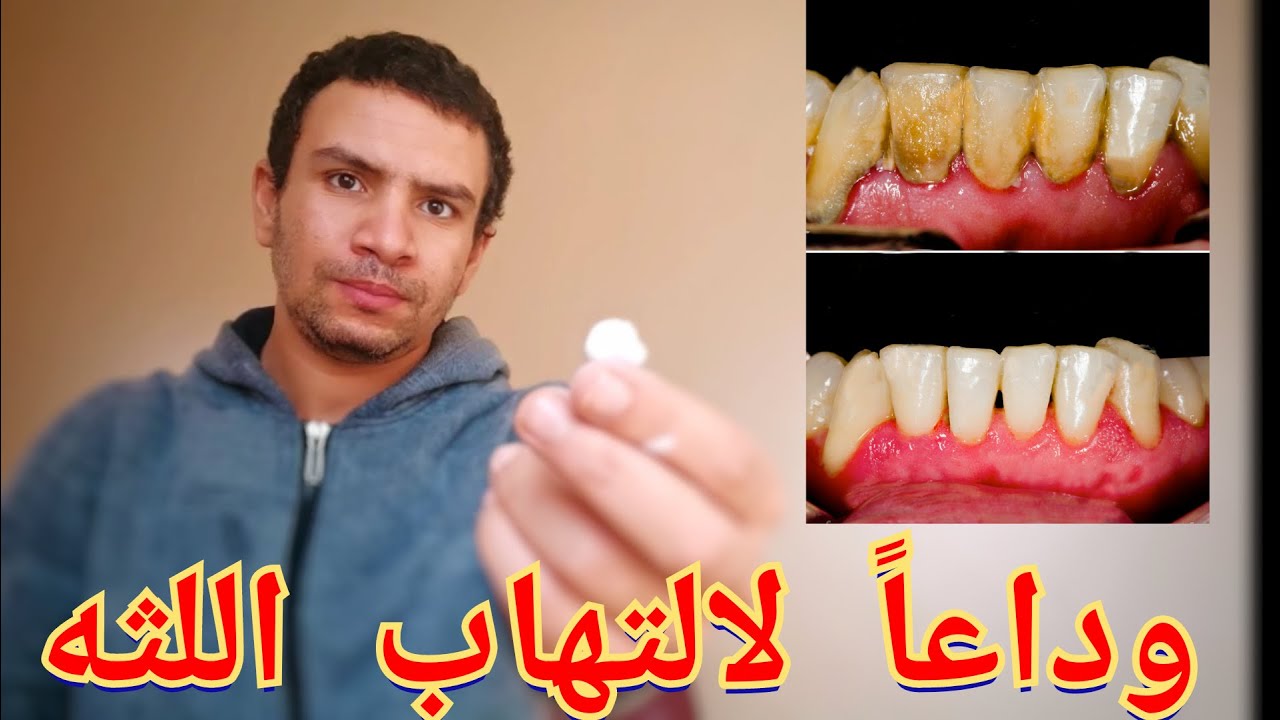 ازاي توقف التهاب اللثه بنفسك خلال ٣ ايام بدون عوده