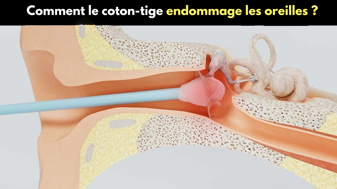 Comment le coton-tige endommage les oreilles ? | Les cotons-tiges sont-ils nocifs ?