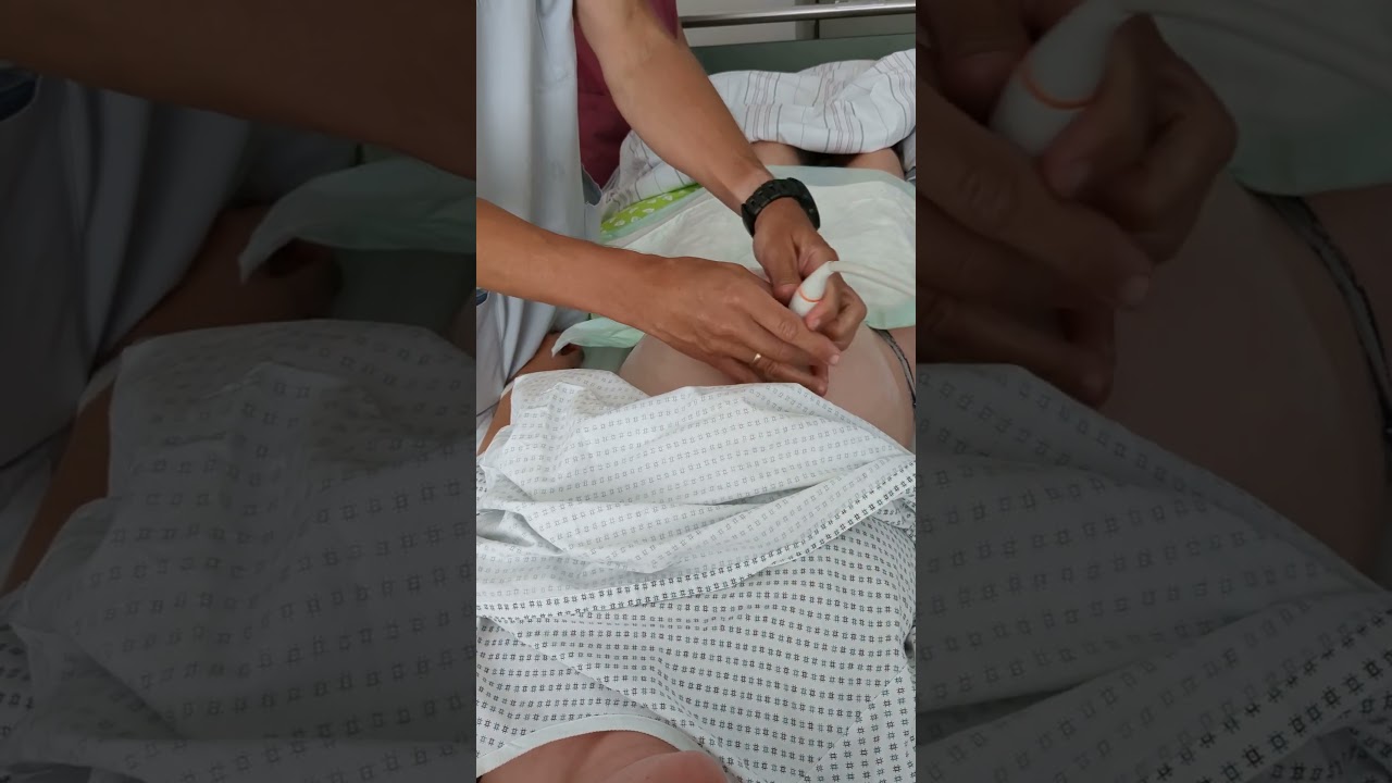 ECV without pain (external cephalic version). For the optimal starting position for vaginal birth.