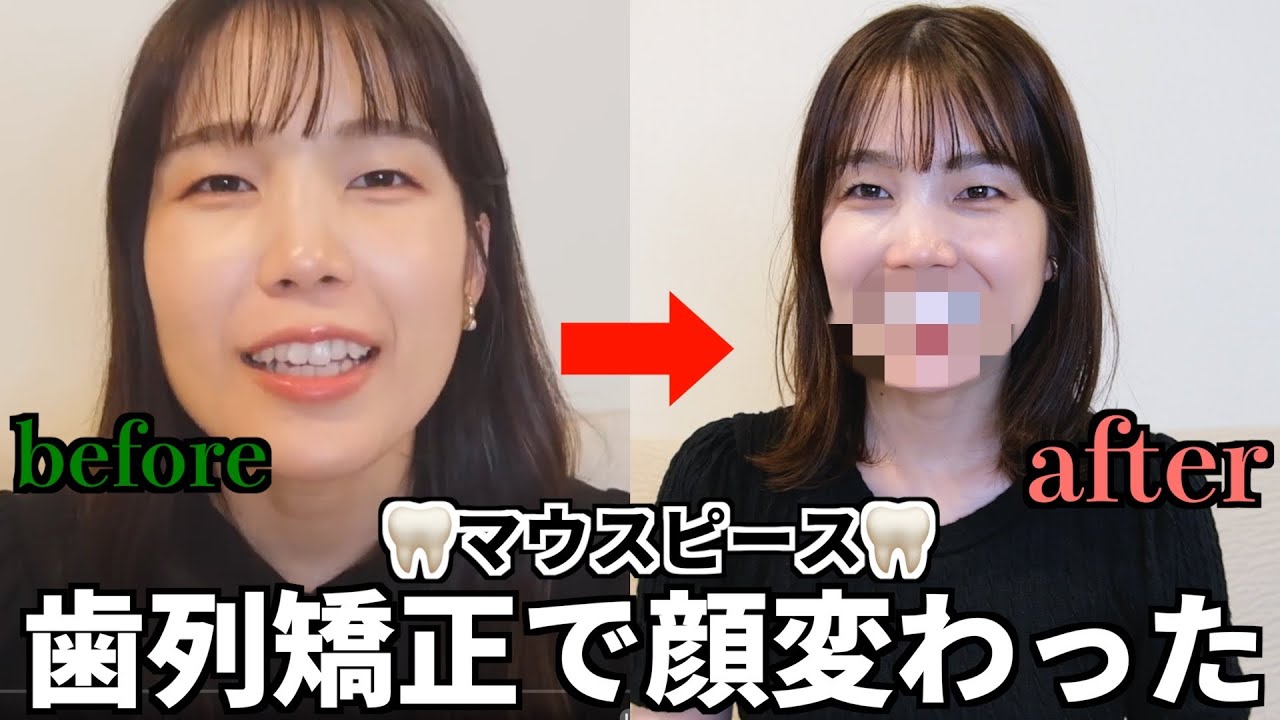 【整形レベル】1年のみマウスピース歯列矯正で大きな変化が…！！やって良かった😭🦷