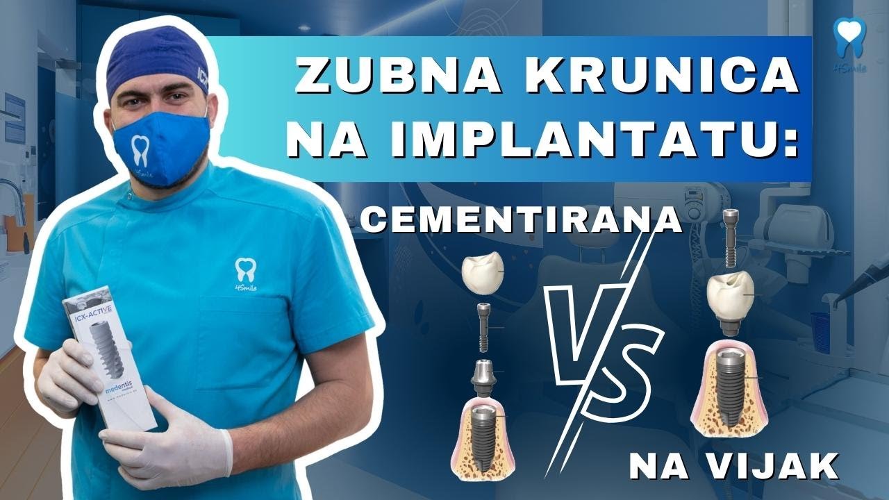 ZUBNA KRUNICA NA IMPLANTATU: Cementirana ili na vijak - Dental Centar 4Smile