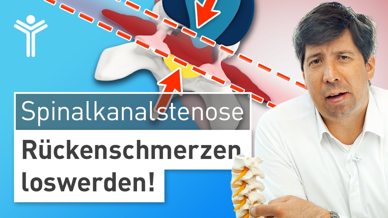 Rückenschmerzen durch Spinalkanalstenose richtig behandeln | Wann operieren?