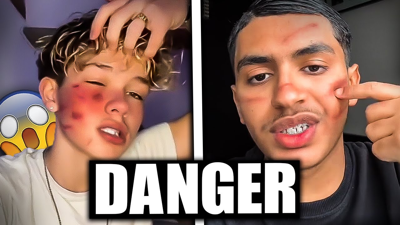 LA PIRE TREND TIKTOK .. (Cicatrice)
