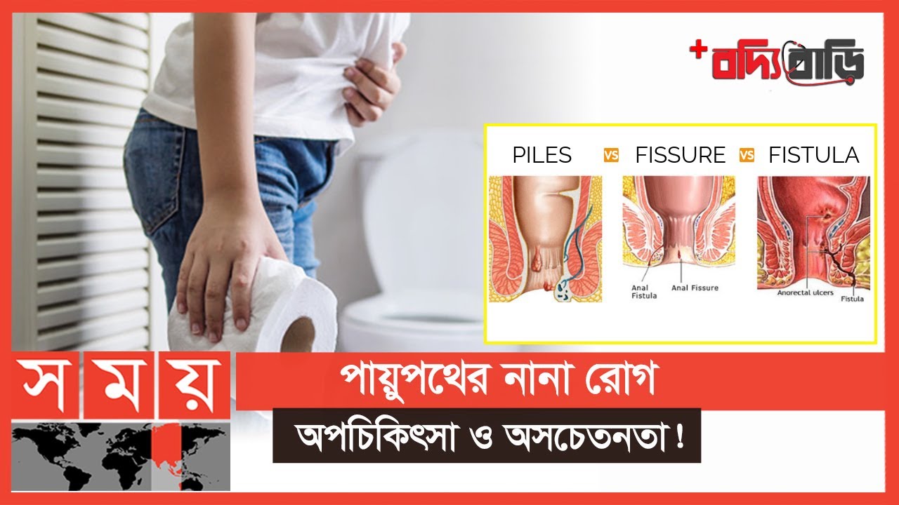 পাইলস, ফিসার ও ফিস্টুলায় আর নয় অবহেলা | বদ্যি বাড়ি | Piles | Fissure | Fistula |Boddi Bari