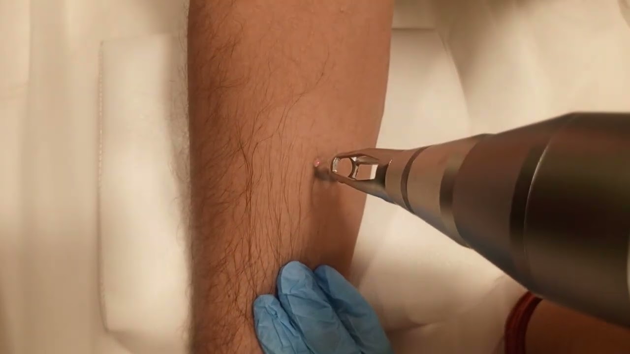 #tatooremoval#lasertatooremoval#noninvasivetreatments 