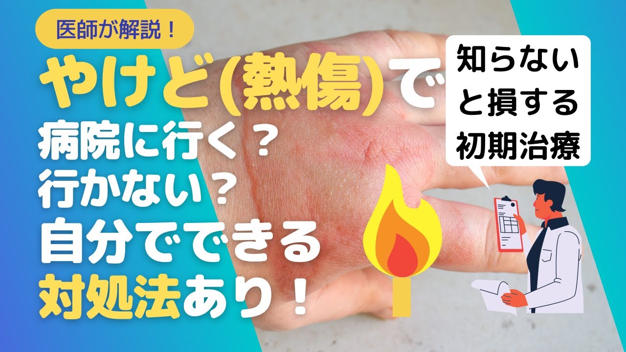 やけど（熱傷・火傷）の初期治療はこれ！病院に行く？行かない？自分でできる対処法あり【医師が解説】