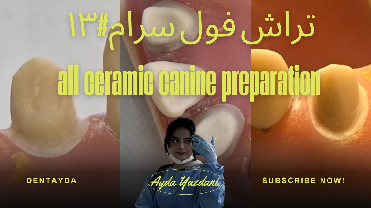 تراش فول سرام کانین با ساده ترین روش ممکن🤩#all_ceramic_preparation #تراش_فول_سرام#۱۳#13#canine#کانین