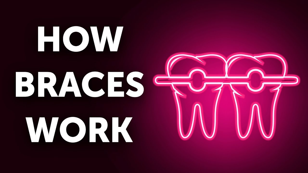 How Braces Work (And Why So Slow)