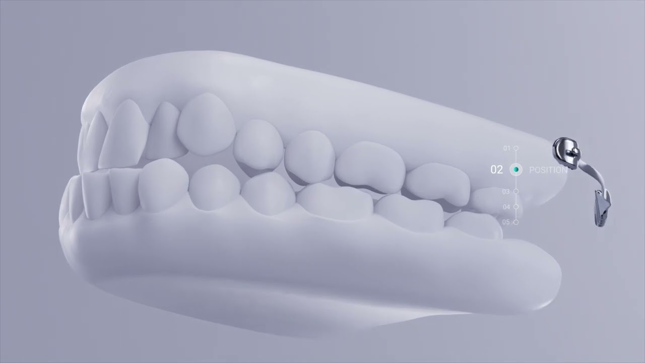 Carriere Motion 3D For Class III with SLX3D Brackets: Doctors Education