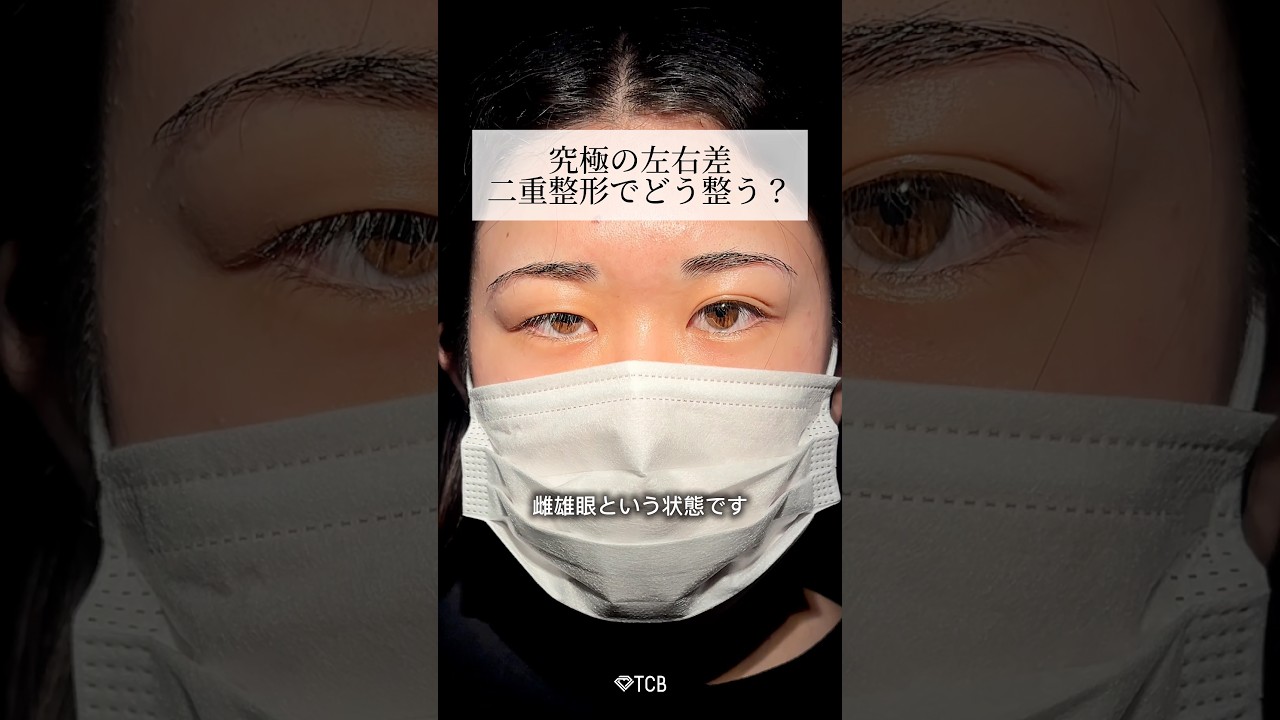 【二重整形】雌雄眼の人はコメントで教えて