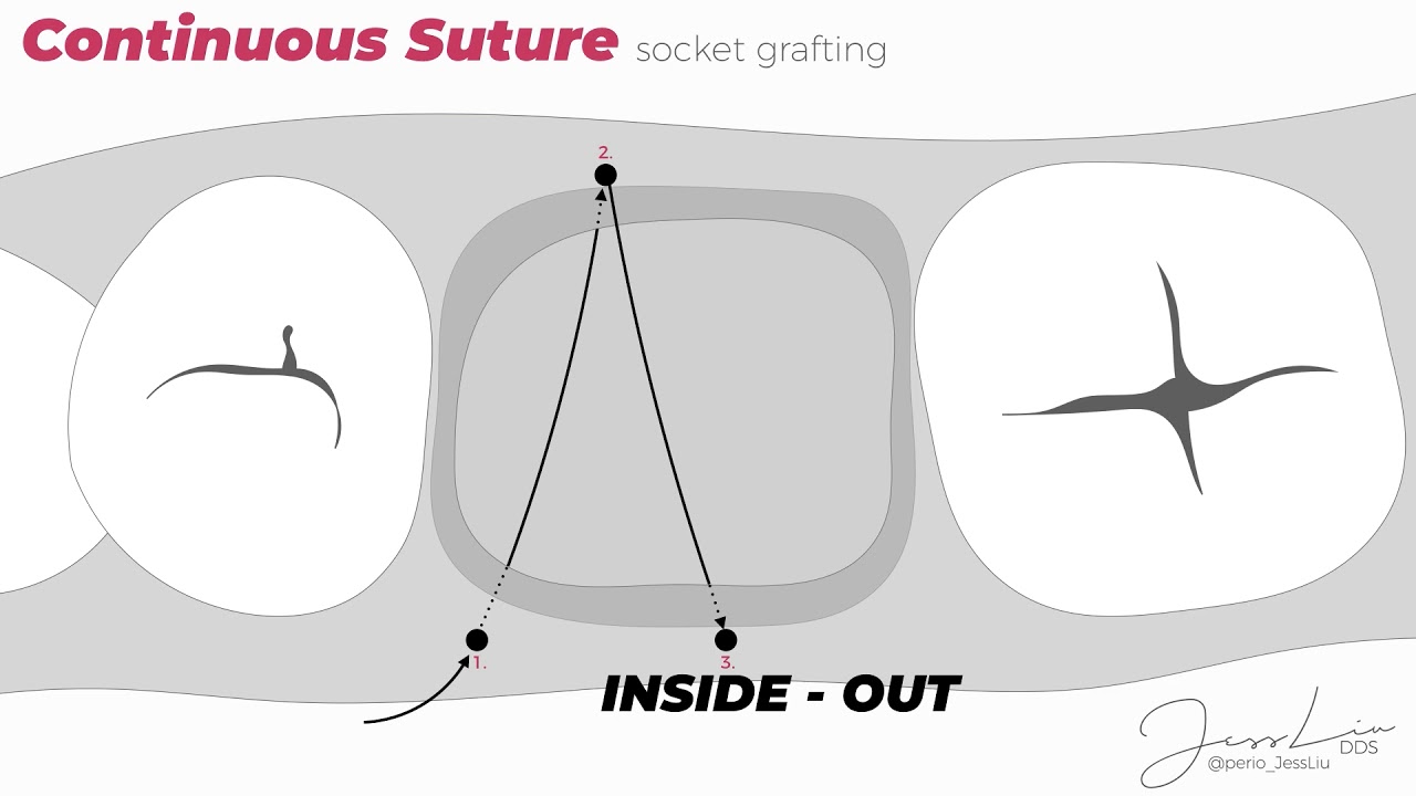 Socket Grafting Suturing Technique