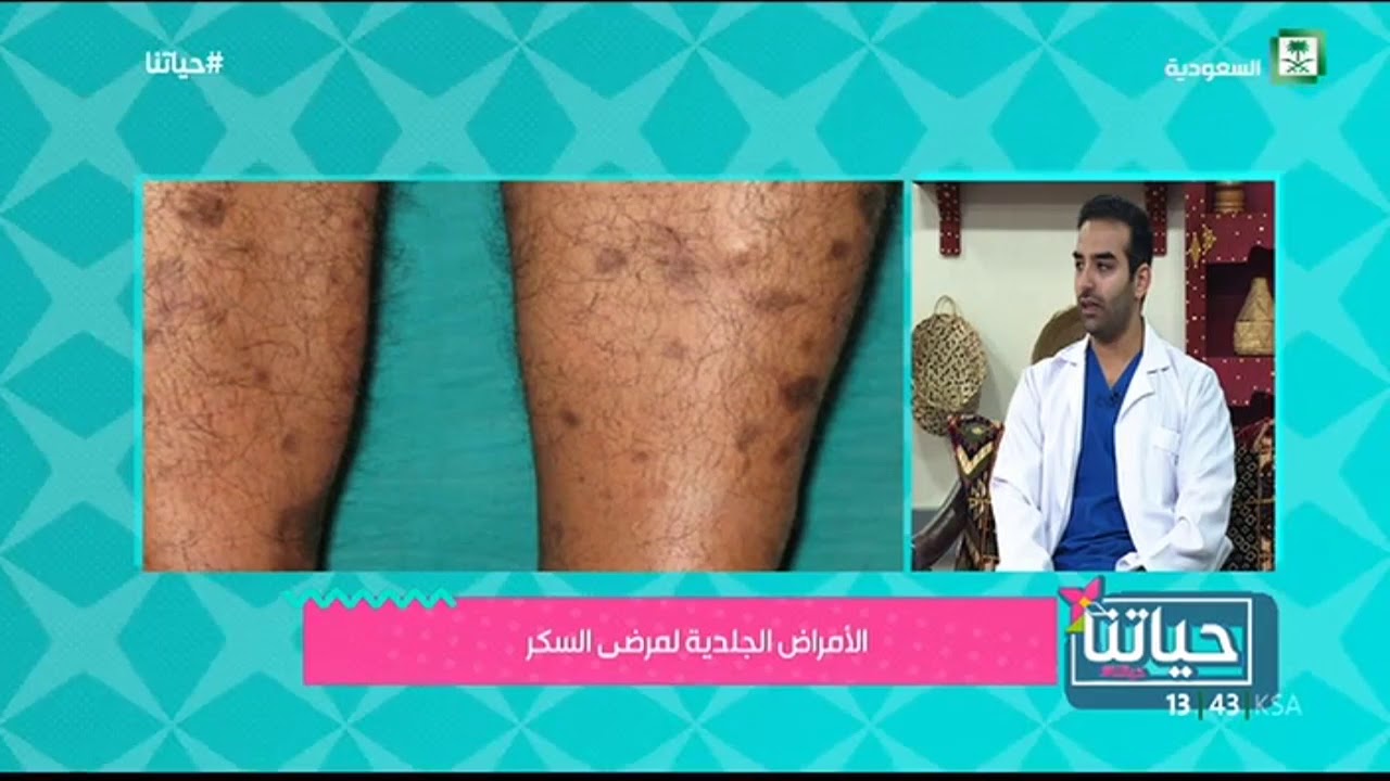 الأمراض الجلدية لمرضى السكري