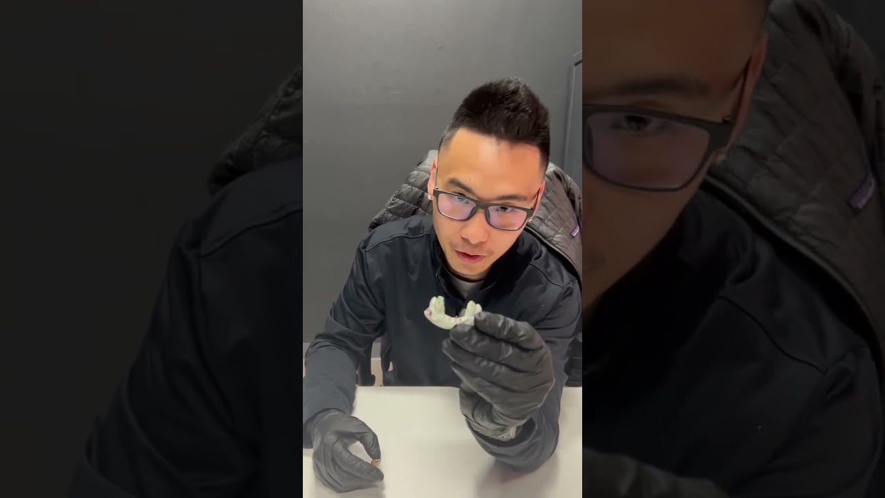 Covering up Missing Teeth with Custom Gold Grillz