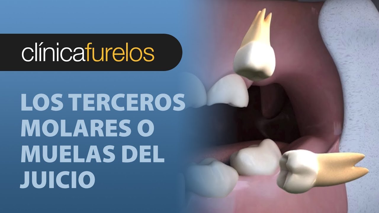 Los terceros molares o muelas del juicio