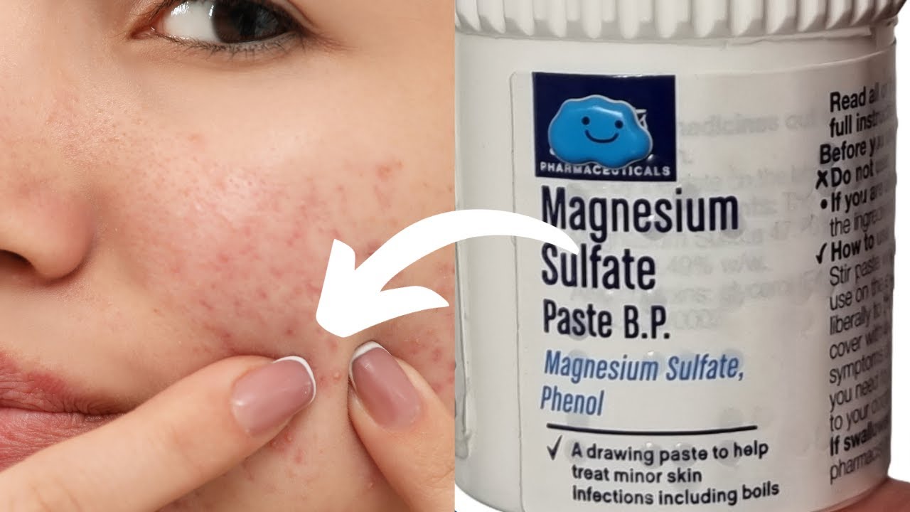 Can you use magnesium sulphate paste on spots? Pharmacist explains
