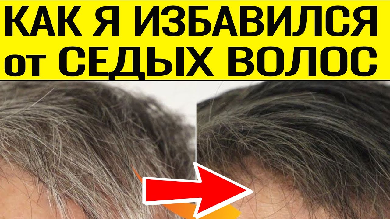 Как Я ИЗБАВИЛСЯ от СЕДИНЫ за 3 МЕСЯЦА
