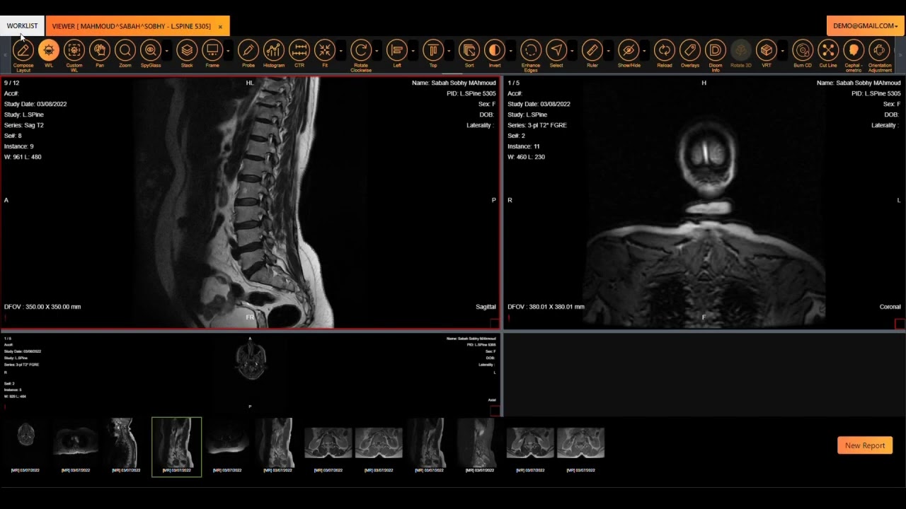 Lumbar Spine Artificial Intelligence model showcase