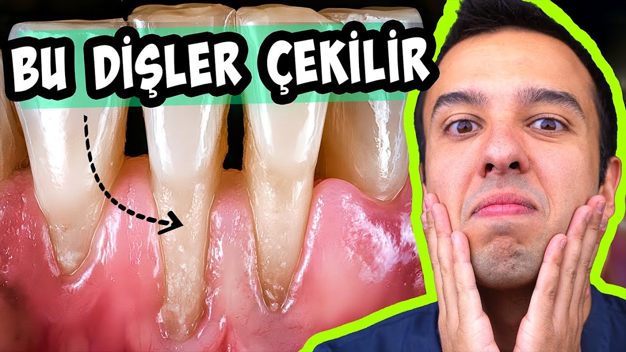 Diş Eti &Ccedil;ekilmesi Tedavisi... Diş Etiniz NEDEN &Ccedil;ekiliyor ? - Dr. Dt. Deniz Ert&uuml;z