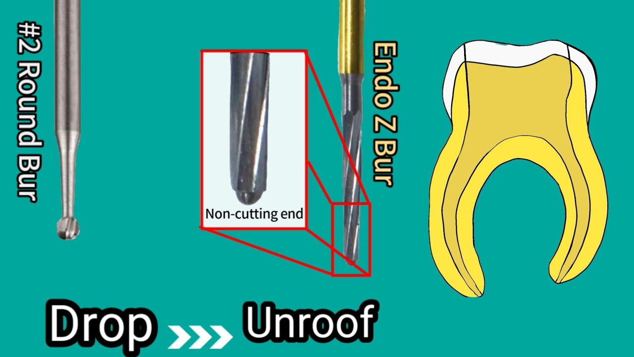 Access cavity preparation _ Molar _ 3 mins