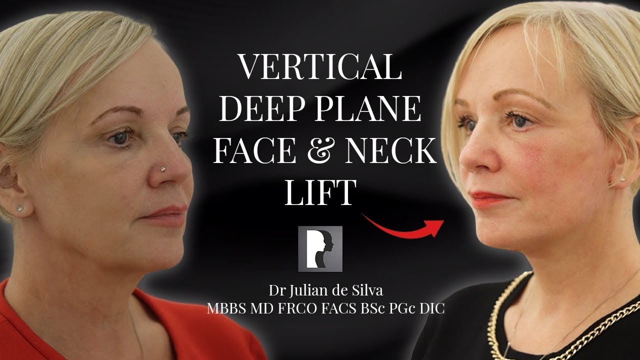 Deep Plane Facelift Reveals Natural Perfection in 6 Weeks - London Facial Plastic Surgery