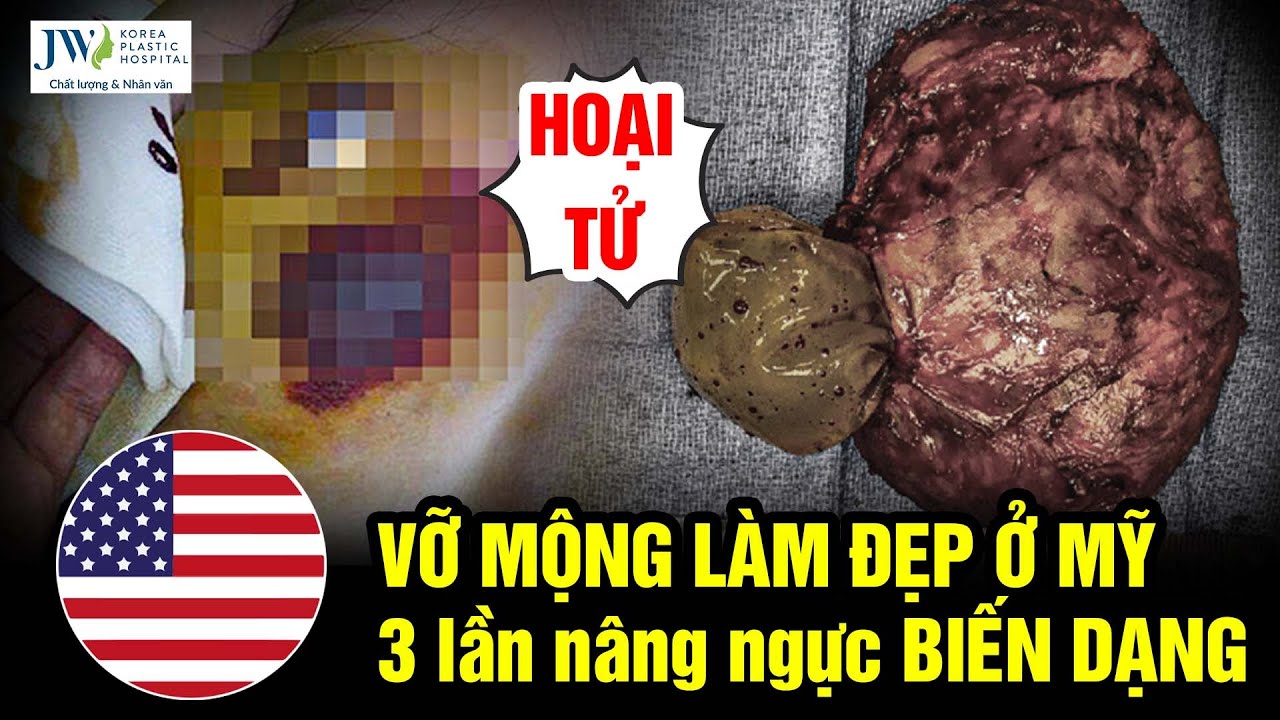Bác sĩ Tú Dung BỨC XÚC người mẫu Việt kiều suýt CẮT BỎ VÒNG 1 sau 3 lần TỐN TIỀN TỶ nâng ngực ở Mỹ