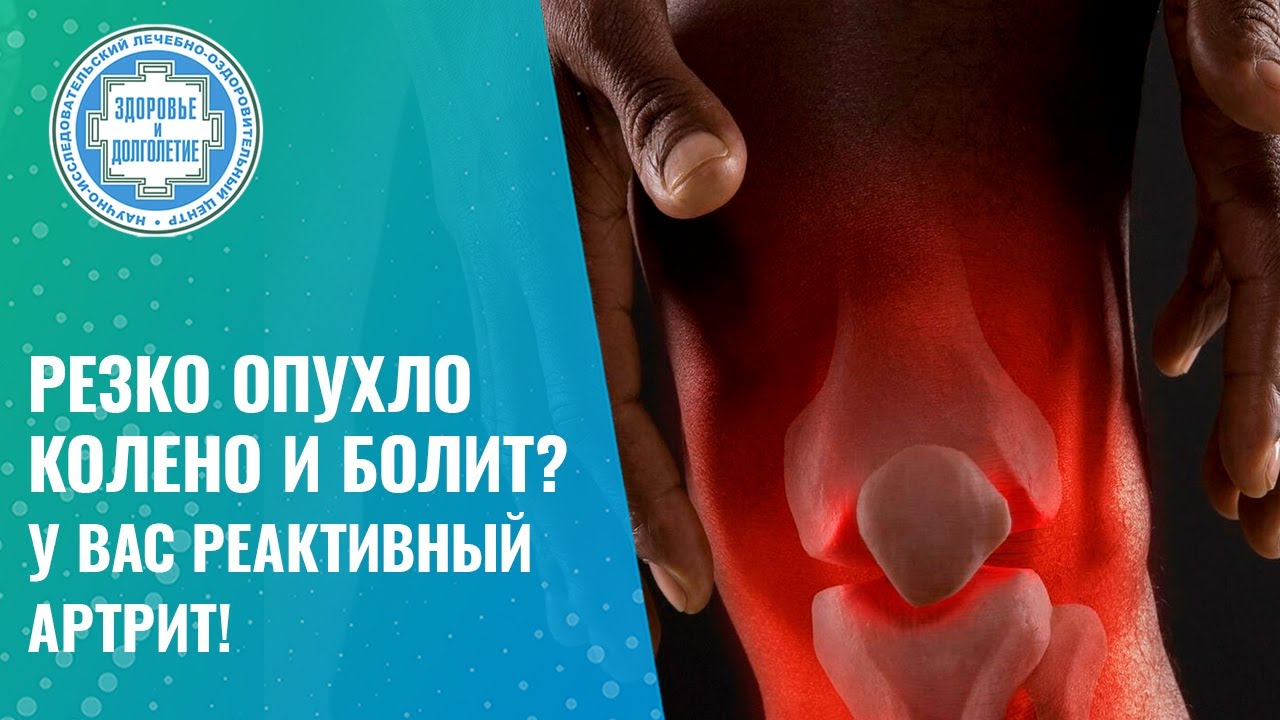 ⚡ РЕАКТИВНЫЙ АРТРИТ. Что это? Причины и лечение