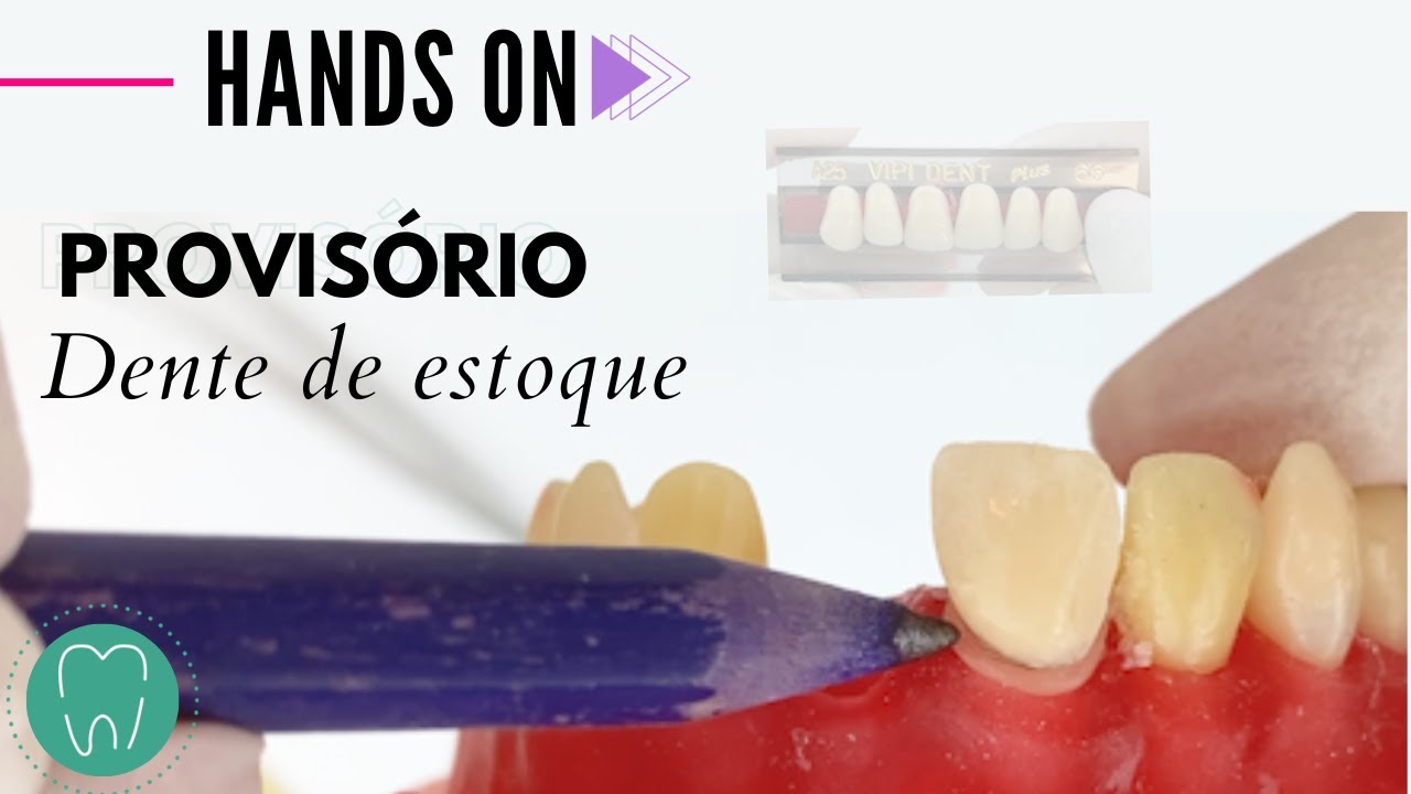 🦷 PROVISÓRIO DENTE ANTERIOR | DENTE DE ESTOQUE