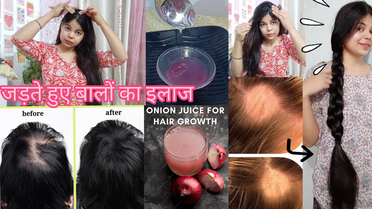  प्याज के रस में यह एक चीज मिलाकर बालों को 10 गुना तेजी से लंबे और घने बनाओ| #naturalbeautywithriya