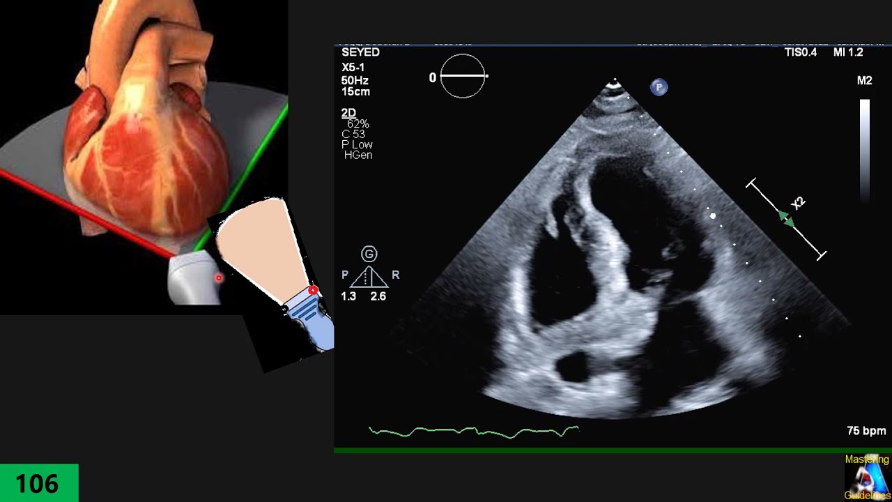 Echocardiographic Anatomy Part 6: Right Ventricle Focused View (RV focused)