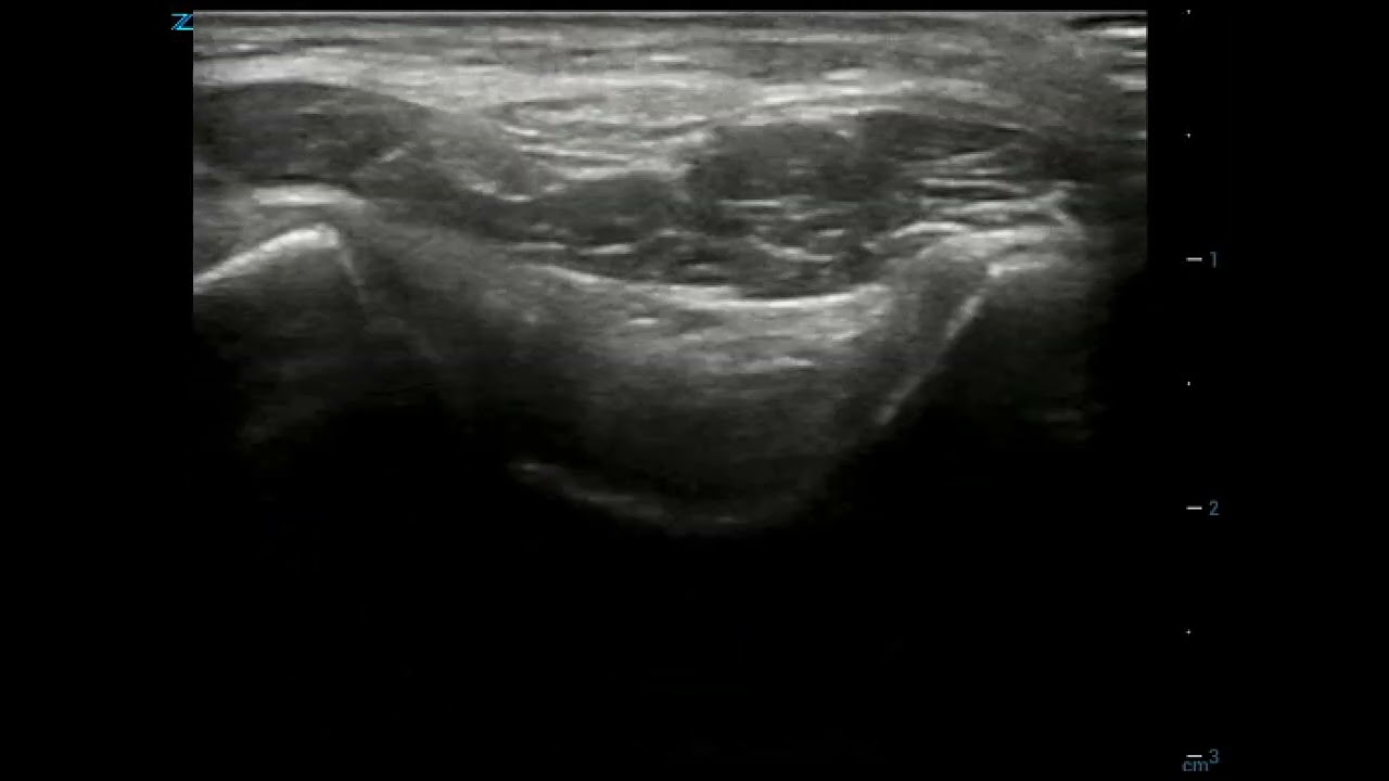 Figure 20B  Normal elbow transverse