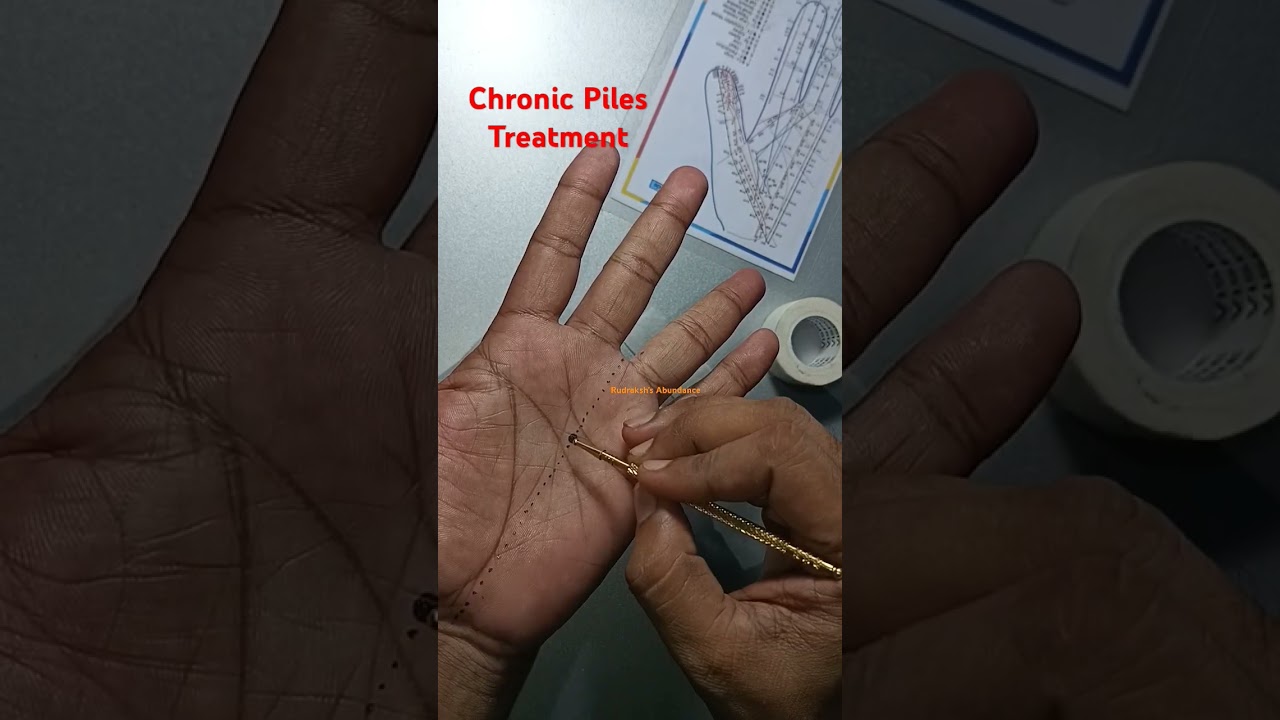 Single point treatment for Chronic Piles 