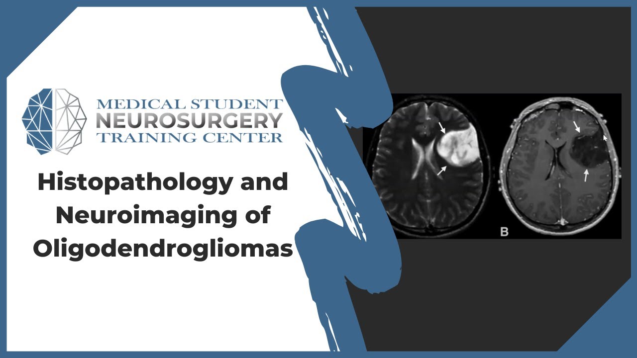 Histopathology and Neuroimaging of Oligodendrogliomas
