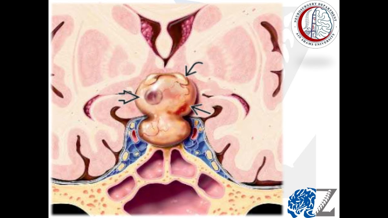 Brain Tumours (42):  Pituitary Adenomas (1)  أورام الغدة النخامية