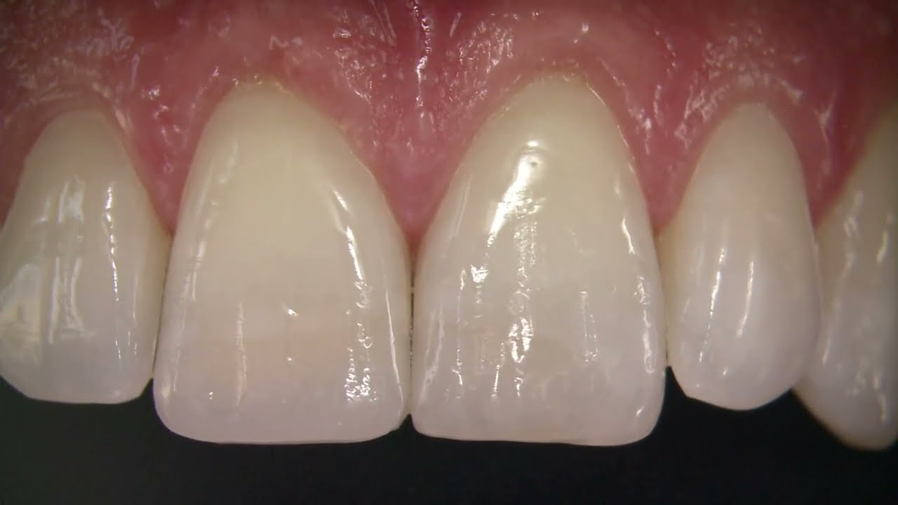 How to repair an old composite restoration - Dr. Lorenzo Vanini