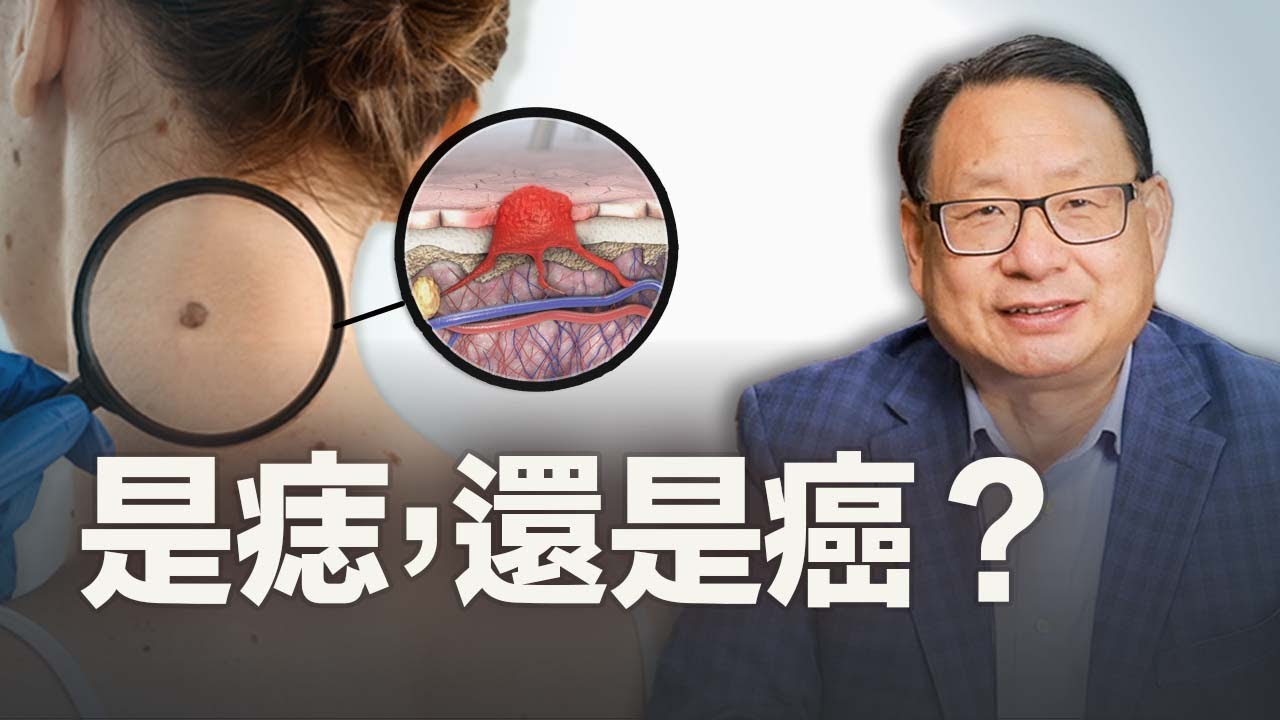 是痣還是黑色素瘤？ 「ABCDE」方法簡單分辨。