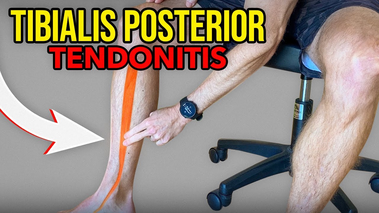 3 Exercises for Tibialis Posterior Tendonitis