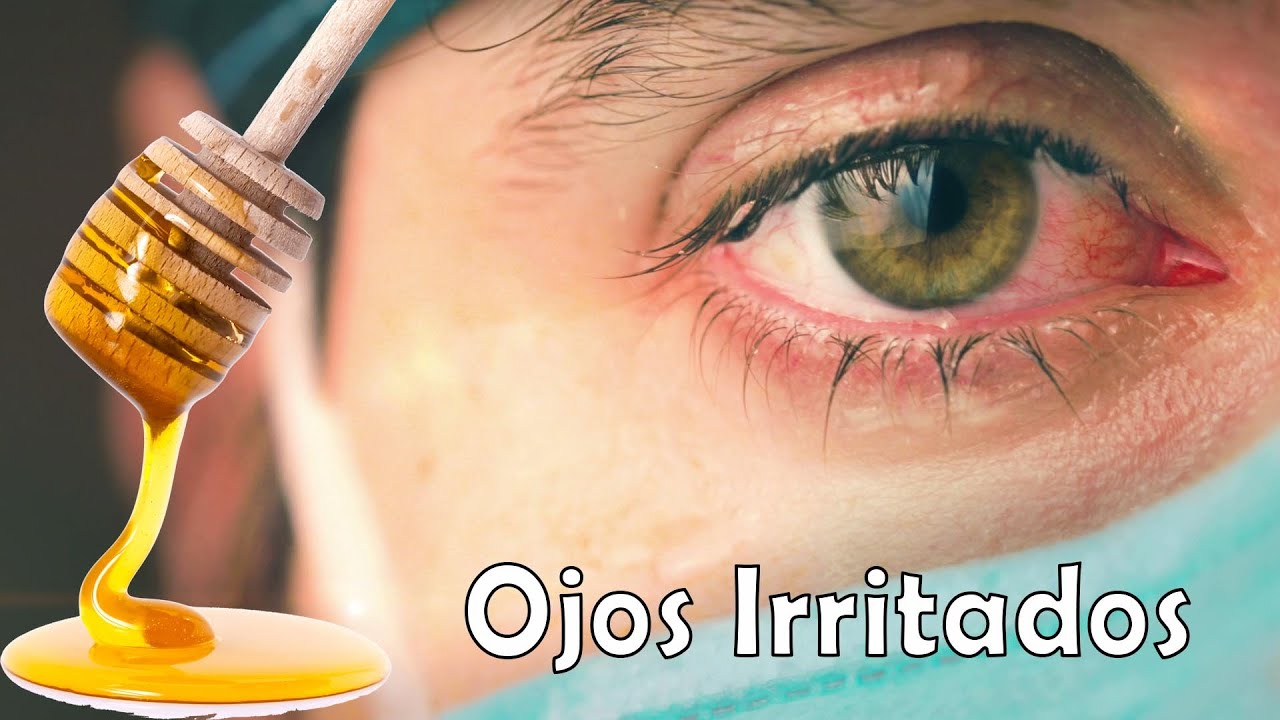 Remedios Naturales Para Los Ojos Irritados