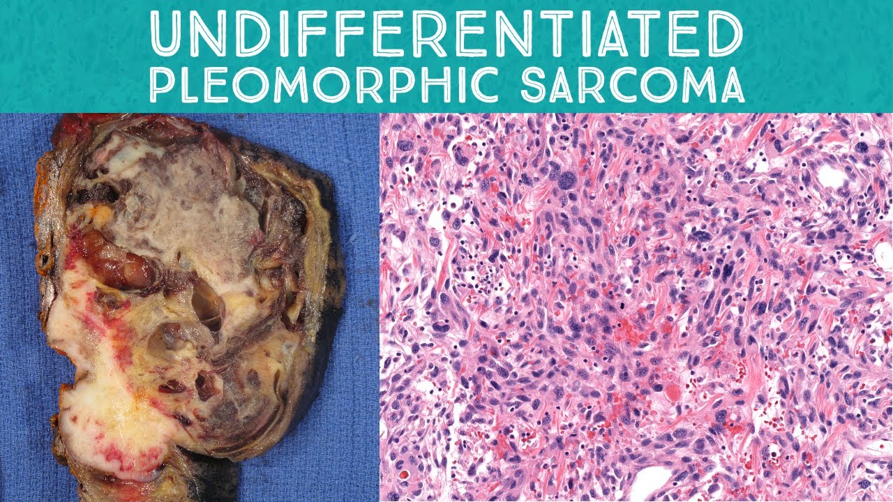 Spindle Cell Neoplasm Pathology 101: Undifferentiated pleomorphic sarcoma vs mimics (Oregon Case 1)
