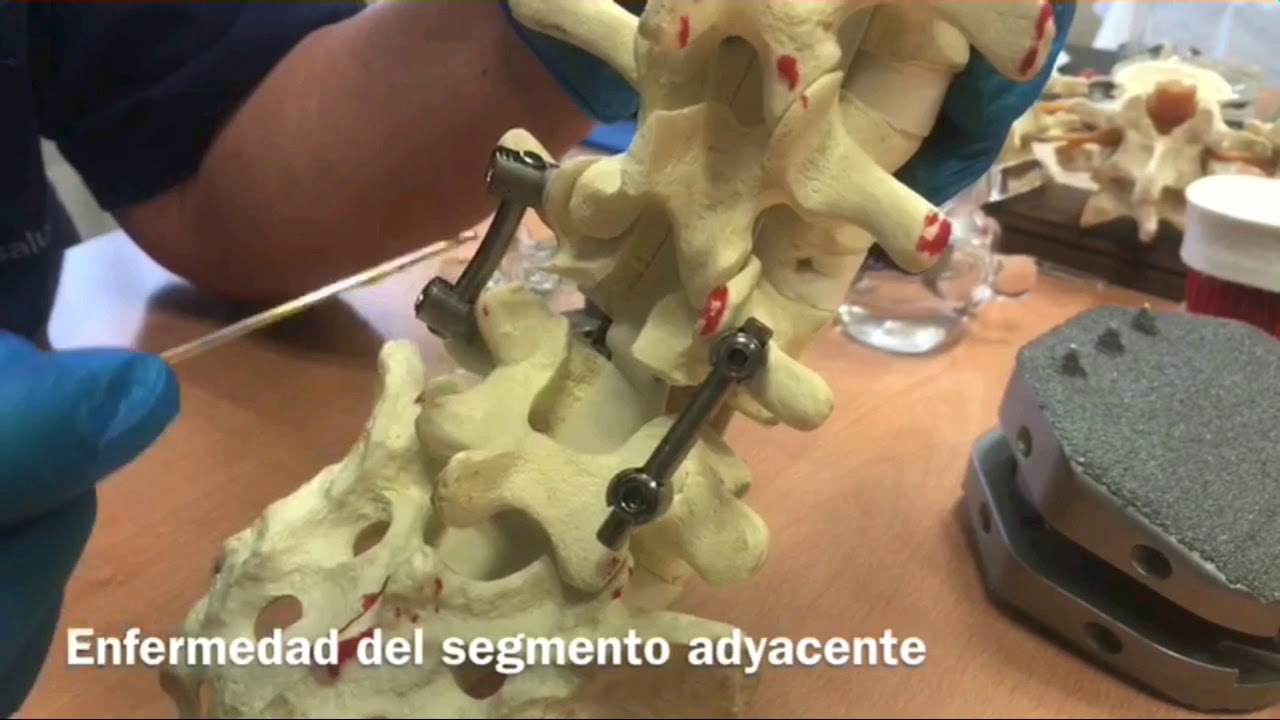 ¿Como puedo tratarme la lumbalgia desde el punto de vista quirúrgico?
